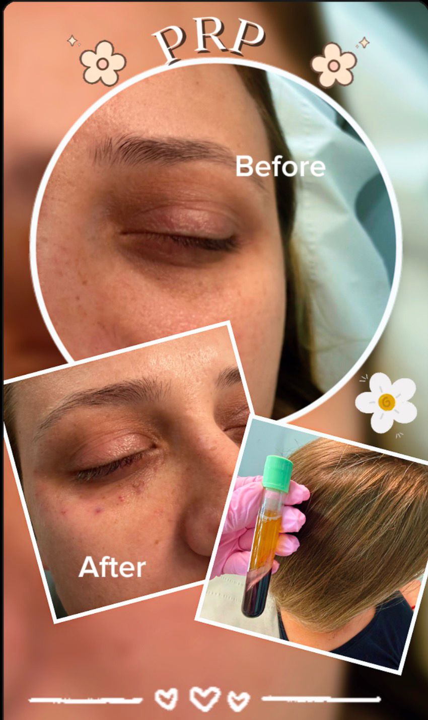 Under Eye Treatment